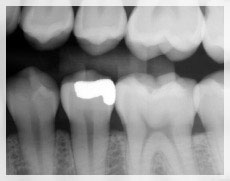 Xray image of a tooth with a filling.